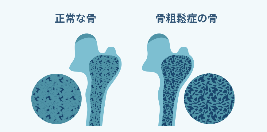 正常な骨と骨粗鬆症の骨のイメージ